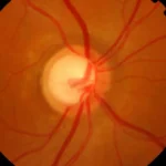 ¿Qué es el glaucoma crónico?