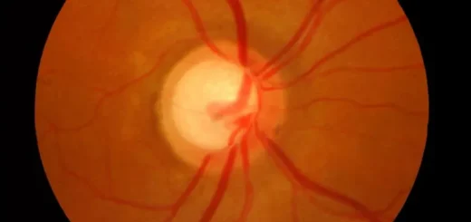 ¿Qué es el glaucoma crónico?