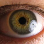 Manifestaciones clínicas del glaucoma crónico