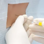 Punción lumbar en pacientes con cefalea