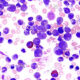 Tratamiento de pacientes con leucemia linfocítica crónica