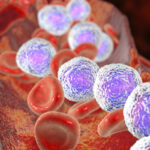 Evaluación de pacientes con leucemia linfocítica crónica