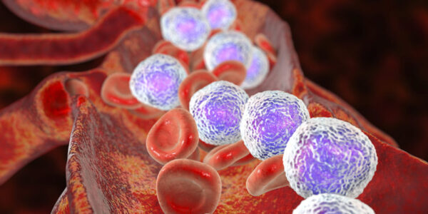 Evaluación de pacientes con leucemia linfocítica crónica