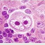 ¿Qué es el linfoma de Hodgkin?