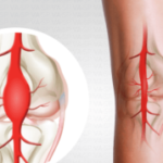 Aneurismas de las arterias periféricas