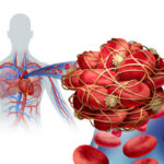 Factores de riesgo de la embolia pulmonar