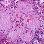 ¿Qué es la amiloidosis renal?