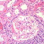 La enfermedad tubulointersticial puede ser aguda o crónica