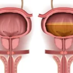 Tratamiento de la hiperactividad del detrusor