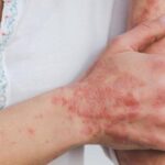 La sarna es una infestación parasitaria