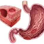 ¿Qué es la enfermedad péptica ulcerosa?