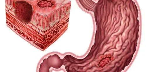 ¿Qué es la enfermedad péptica ulcerosa?