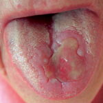 Manifestaciones clínicas de la enfermedad de Behçet