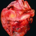 Cambios en el pericardio por inflamación