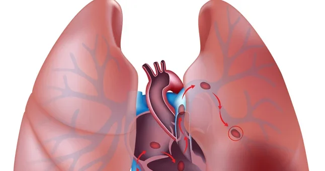 Puntaje de Wells para el diagnóstico de embolia pulmonar
