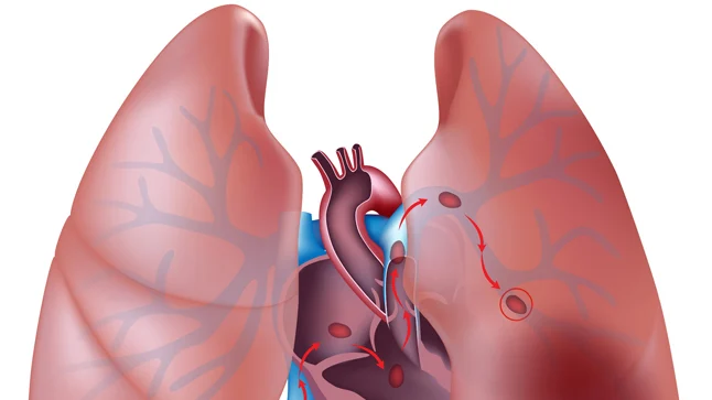 Puntaje de Wells para el diagnóstico de embolia pulmonar