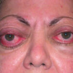 ¿Qué es la orbitopatía de Graves?