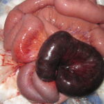 ¿Qué es la isquemia mesentérica?