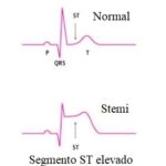 ¿Qué puede causar un infarto agudo de miocardio con elevación del segmento ST?