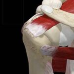 ¿Qué son los desgarros del manguito del rotador del hombro?