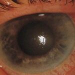 Causas de glaucoma primario de ángulo cerrado agudo