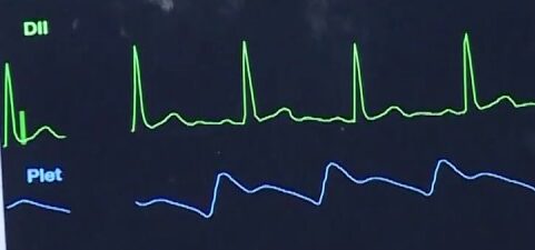 Monitoreo cardiaco con la derivación DII