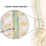 Administración intratecal de medicamentos