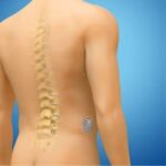 Estimulación de la médula espinal para manejo del dolor