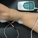 ¿Para que sirve la estimulación de nervio pariférico?