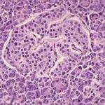 Patogenia de la diabetes mellitus tipo 1