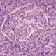 Patogenia de la diabetes mellitus tipo 1