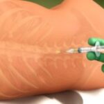 Inyecciones epidurales de corticosteroides