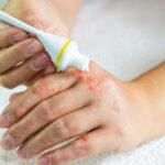 Complicaciones del tratamiento dermatológico tópico