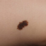 ¿Qué son los nevos melanocíticos?