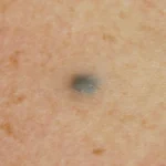 ¿Qué son los nevos azules?