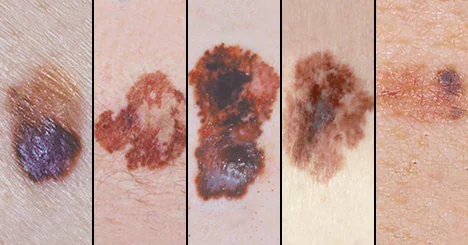 Clasificación clínica e histopatológica de los melanomas