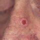 Características de los carcinomas basocelulares