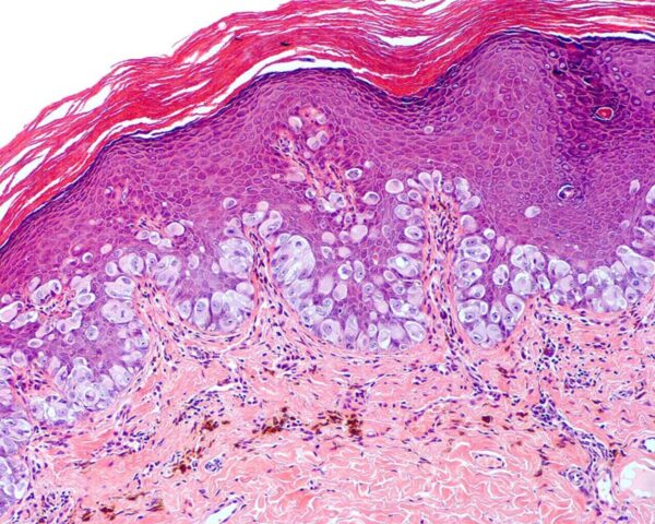 ¿Qué es la enfermedad extramamaria de Paget?