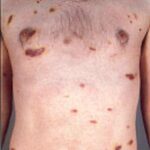 Tratamiento del sarcoma de Kaposi