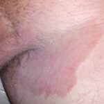 Tinea cruris o tiña inguinal