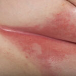 El intertrigo es una irritación cutánea