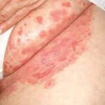 Tratamiento de la candidiasis mucocutánea