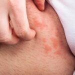 Manifestaciones clínicas de la candidiasis mucocutánea