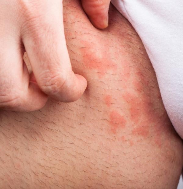 Manifestaciones clínicas de la candidiasis mucocutánea