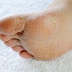 Tratamiento de la tiña de pies y manos