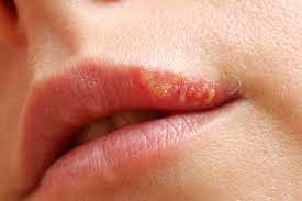 Infección por virus herpes simple