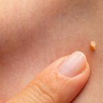 Las verrugas son causadas por el virus del papiloma humano