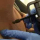Tratamiento de las verrugas no genitales