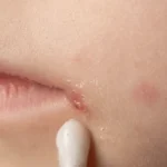 ¿Cuál es el tratamiento del impétigo?
