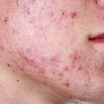 ¿Qué es la sicosis?